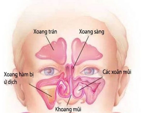 viêm xoang mũi