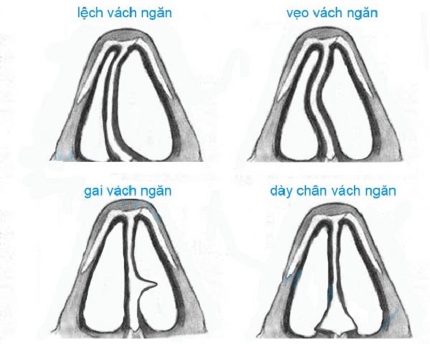Mổ vẹo vách ngăn mũi có thực sự cần thiết?