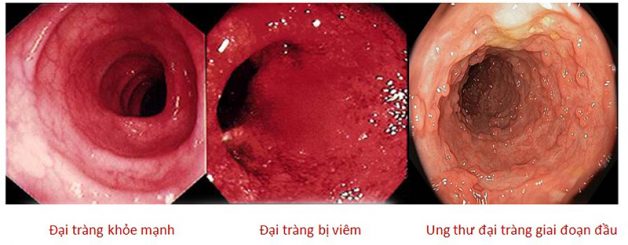 Vì sao xét nghiệm ung thư đại tràng quan trọng và cần thiết?