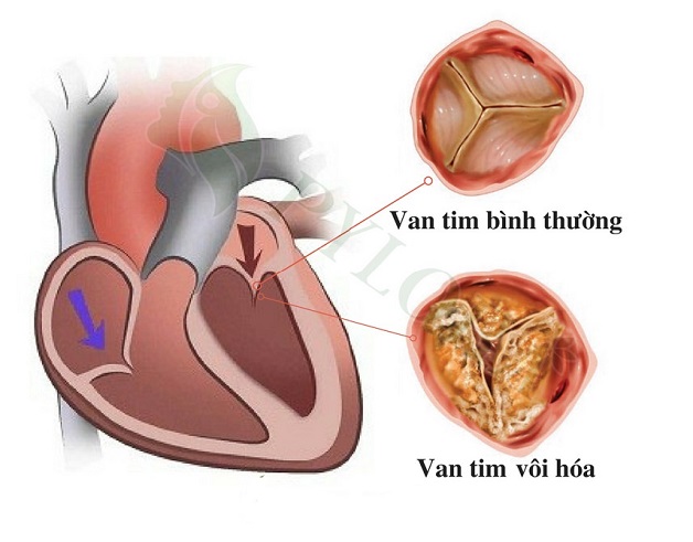Nguyên nhân hẹp van tim 2 lá phổ biến