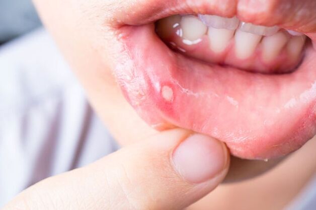 nhiệt miệng thiếu vitamin gì