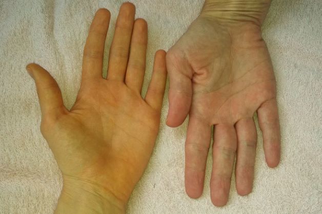 Ung thư tụy sau phẫu thuật nên ăn gì