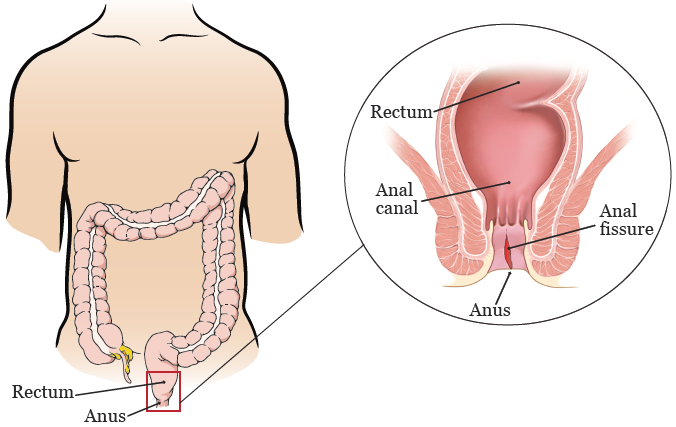Bệnh nứt kẽ hậu môn gây đau dữ dội và chảy máu đỏ tươi trong và sau khi đi đại tiện