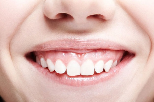 Nướu phát triển quá dày là một trong nguyên nhân khiến cười hở lợi. 