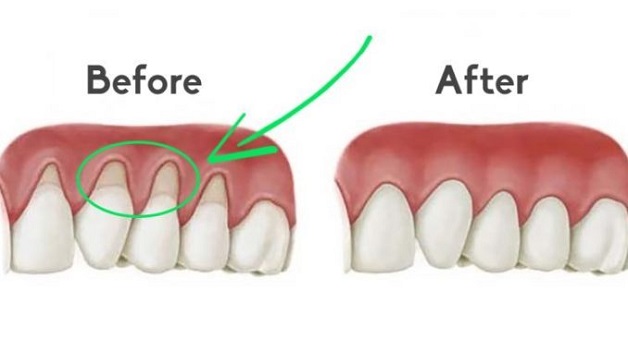 Phẫu thuật ghép lợi có khả năng che phủ chân răng và tái tạo mô nướu rất hiệu quả