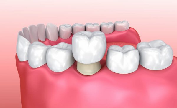 bọc sứ răng hàm là phương pháp gì