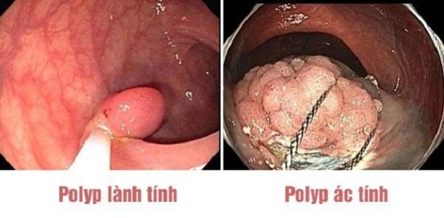90% trường hợp ung thư trực tràng tiến triển từ polyp và đây là loại ung thư chiếm tỷ lệ khá cao ở cả nam và nữ