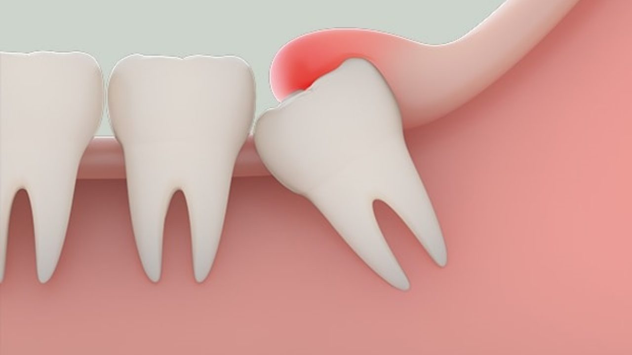 các trường hợp răng khôn mọc lệch