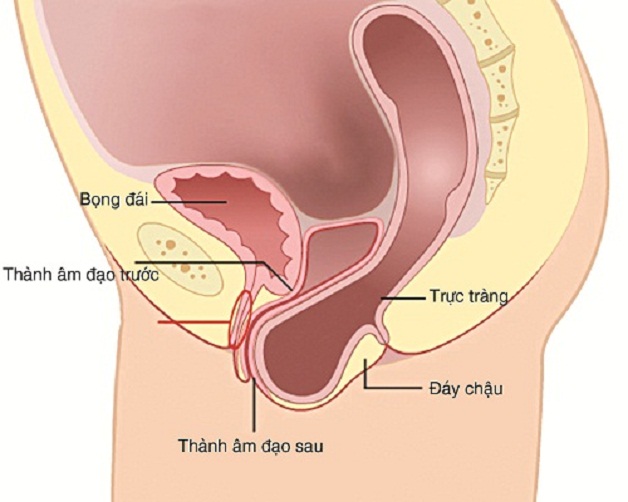 Sa trực tràng kiểu túi là sự suy giảm độ co giãn của lớp màng cơ ngăn cách giữa trực tràng và âm đạo