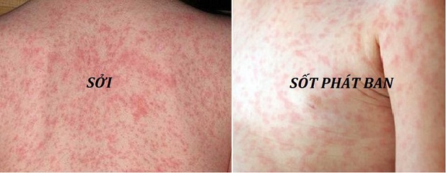 Với bệnh sốt phát ban và sởi, mẹ cần phân biệt qua nốt ban nổi trên da bé.