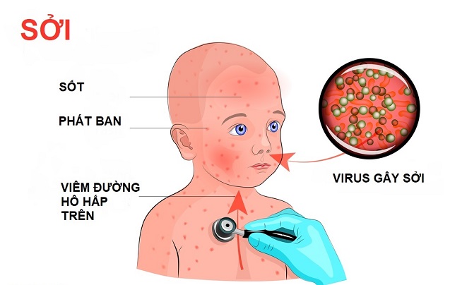 Với bệnh sốt phát ban, đa số các trường hợp nhiễm bệnh là do có nguyên nhân là nhiễm virus thông thường.