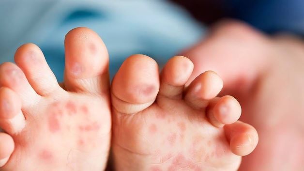 Phát ban là dấu hiệu của sốt siêu vi khi đã đi qua giai đoạn ủ bệnh và phát bệnh, khiến các nốt mẩn đỏ li ti xuất hiện ở tay hoặc chân.