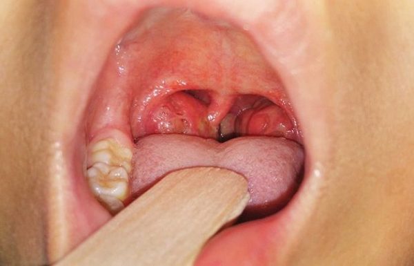 sưng amidan sốt