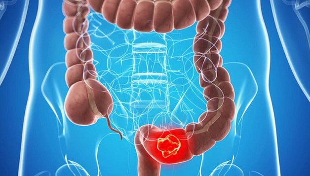 tắc ruột là gì? tắc ruột có phải mổ không?