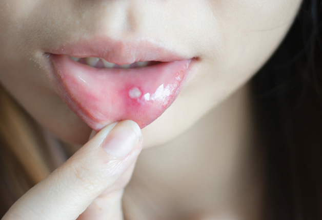 Tại sao nhiệt miệng lâu khỏi