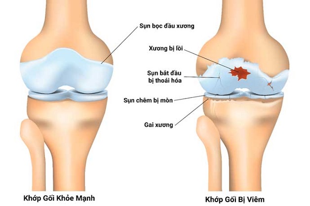 Thoái hóa khớp gối là gì - Định nghĩa