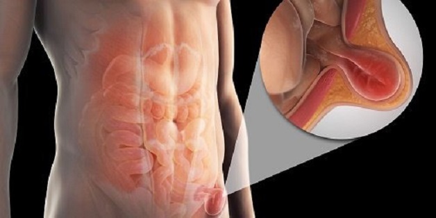 Hỏi đáp thoát vị bẹn trên siêu âm