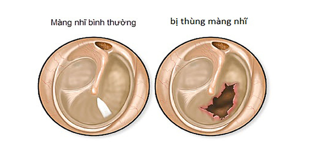 thủng màng nhĩ có chảy máu nhiều không
