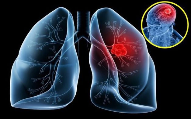 Xét nghiệm chẩn đoán ung thư phổi thực hiện như thế nào?