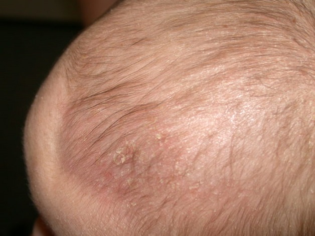 trẻ bị nổi mụn trên đầu