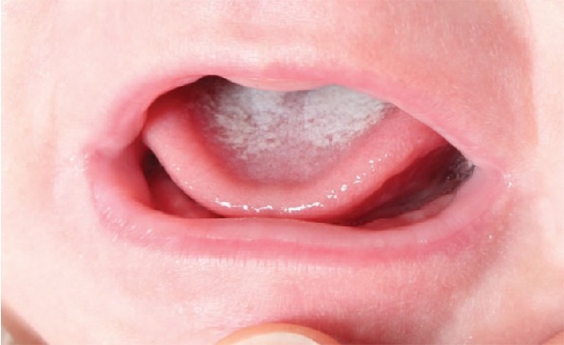 Trẻ bị nổi mụn trắng trong miệng là căn bệnh thường gặp