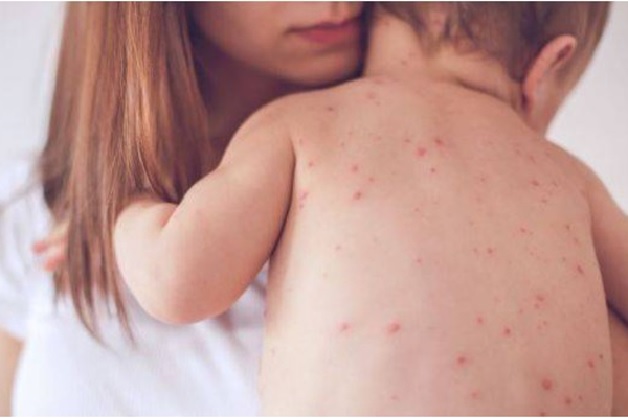 Trẻ mắc bệnh tay chân miệng có cần kiêng gió không là thắc mắc của nhiều bố mẹ