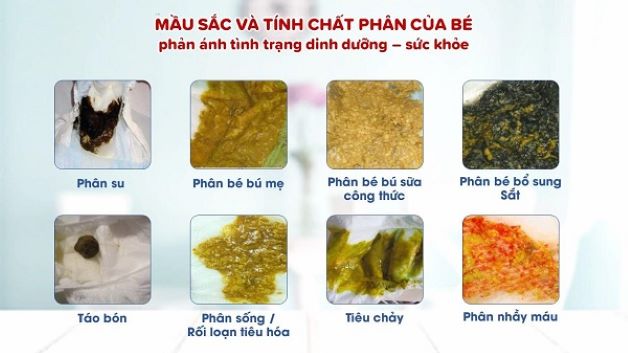 Dựa vào đặc điểm và tính chất của phân ở trẻ sơ sinh mà cha mẹ có thể biết trở đang gặp vấn đề gì hay không