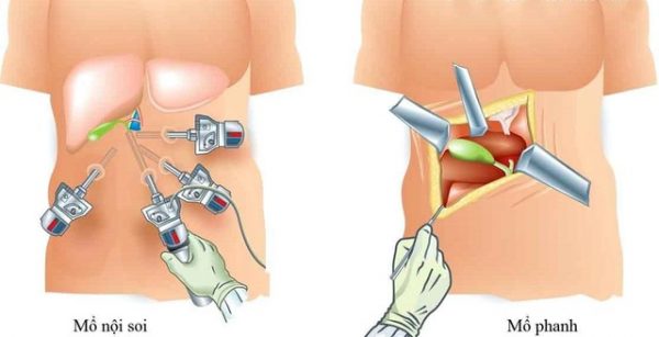 Túi mật có Polyp là gì? Nguyên nhân và cách điều trị Polyp túi mật là gì? Nguyên nhân và cách điều trị