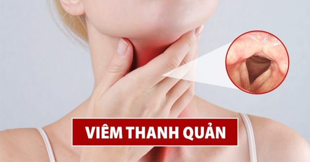 U xơ dây thanh quản - Bệnh lý nhiều tên gọi