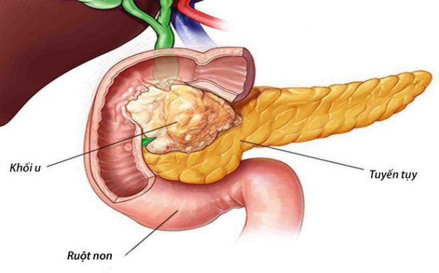 Tổng quan về u tuyến tụy giai đoạn cuối
