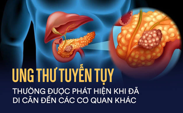 ung thư tụy là ung thư gì
