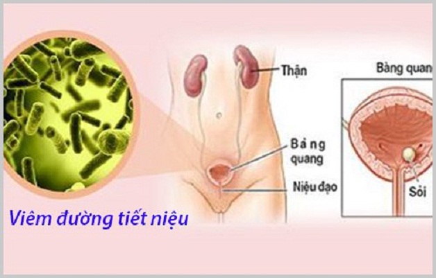 Chẩn đoán viêm đường tiết niệu cần xét nghiệm gì là câu hỏi mà nhiều người bệnh quan tâm