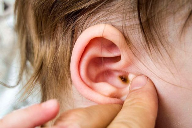 Phòng ngừa và điều trị viêm tai ngoài như thế nào?