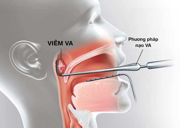 Mô phỏng hình ảnh viêm VA