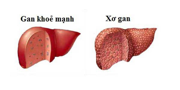 Gan bị tổn thương sẽ có bề mặt sần sùi, nổi nhiều cục u