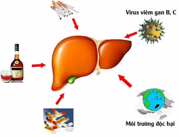 Xơ gan do nhiều nguyên nhân gây ra.