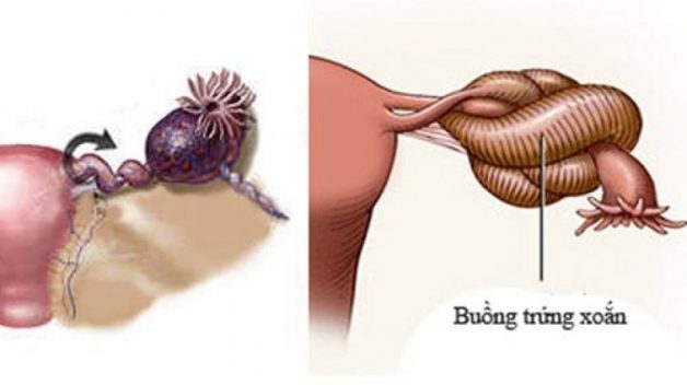 U nang buồng trứng và những hệ lụy khó lường
