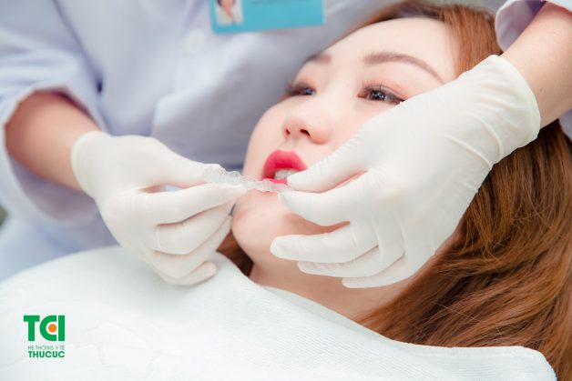 Nẹp răng trong suốt Invisalign là phương pháp tân tiến nhất hiện nay loại bỏ hoàn toàn bộ ba truyền thống mắc cài, dây cung và dây chun và thay thế bằng khay nhựa trong suốt