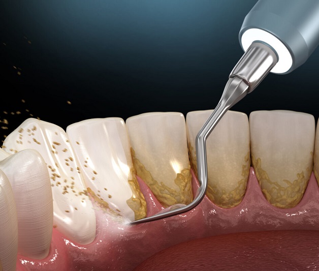 Bao lâu lấy cao răng 1 lần? Thời gian tốt nhất khoảng 6 tháng