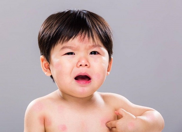 bé bị nổi mẩn đỏ quanh mắt do đâu