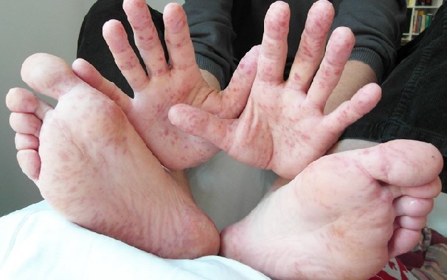 Bệnh tay chân miệng lây lan qua nhiều con đường khác nhau