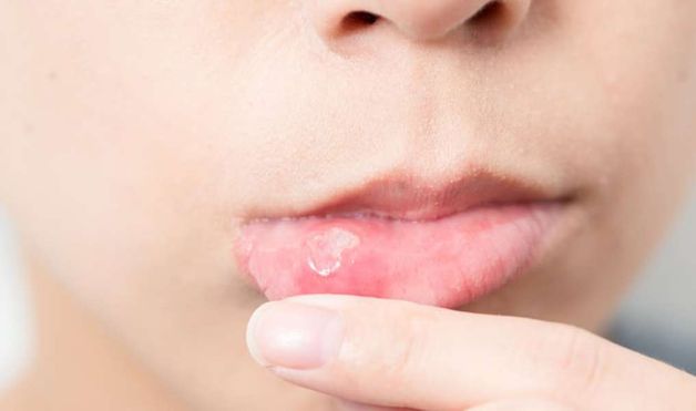 cách trị nhiệt miệng