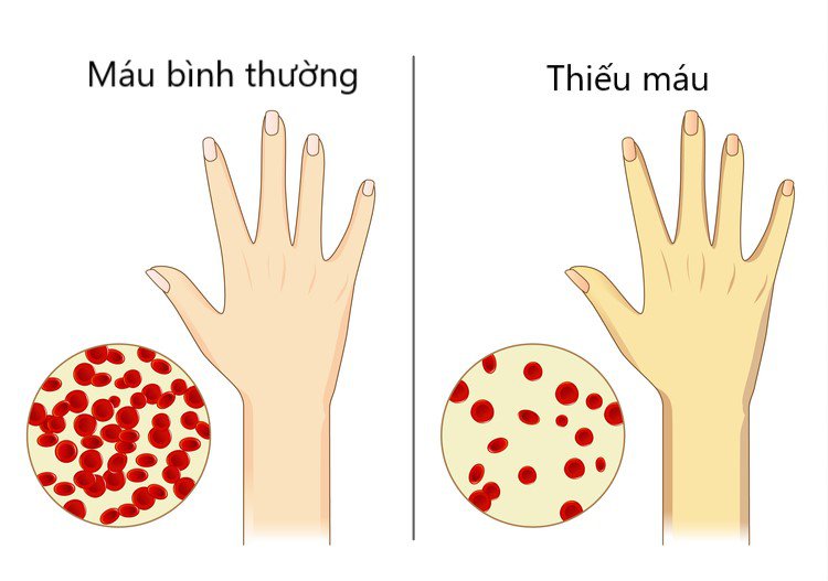 Trẻ thiếu máu khiến da xanh xao