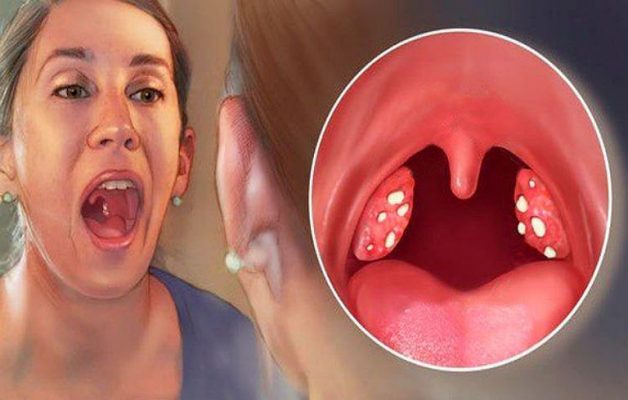 Viêm họng hạt hôi miệng do nguyên nhân nào gây nên?