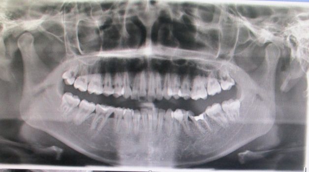 Để kiểm tra tình trạng răng của bệnh nhân, bác sĩ sẽ thăm khám và chỉ định chụp X-quang răng