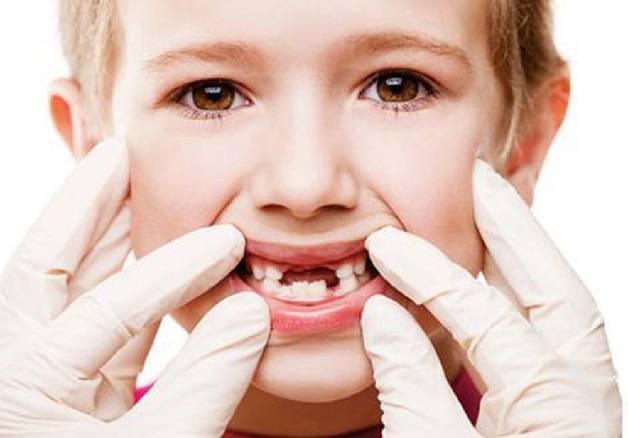 Có rất nhiều nguyên nhân khiến trẻ 6 tuổi bị sâu răng