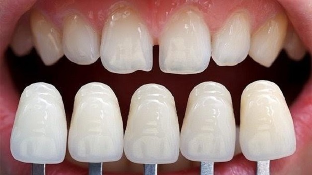 Đắp khe răng thưa, bác sĩ nha khoa sẽ giảm khoảng hở của các khe thưa bằng cách tăng kích thước giữa các răng, từ đó cải thiện thẩm mỹ của hàm răng