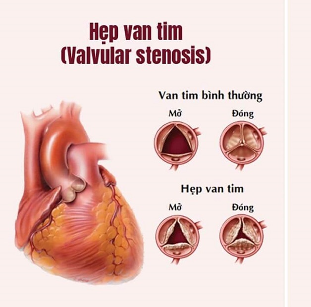 Các dấu hiệu của bệnh hẹp van tim rất đa dạng, tùy theo van tim bị hẹp, mức độ hẹp và nguyên nhân gây hẹp van 