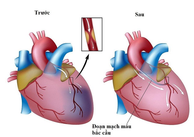 Nếu sử dụng thuốc không hiệu quả, bệnh nhân có thể phải phẫu thuật để điều trị tắc động mạch vành