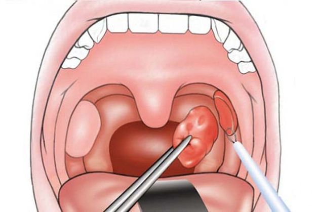 cắt amidan bao lâu thì nói được ăn được